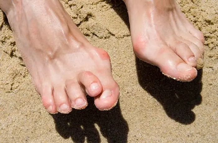 Reason To Skip Flip-Flops #1: Your Toe Extends Over The Next One