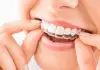 Top 10 Clinics for Invisalign in Singapore