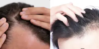 8 Recommended Places To Go For Hair Loss Treatments in Singapore